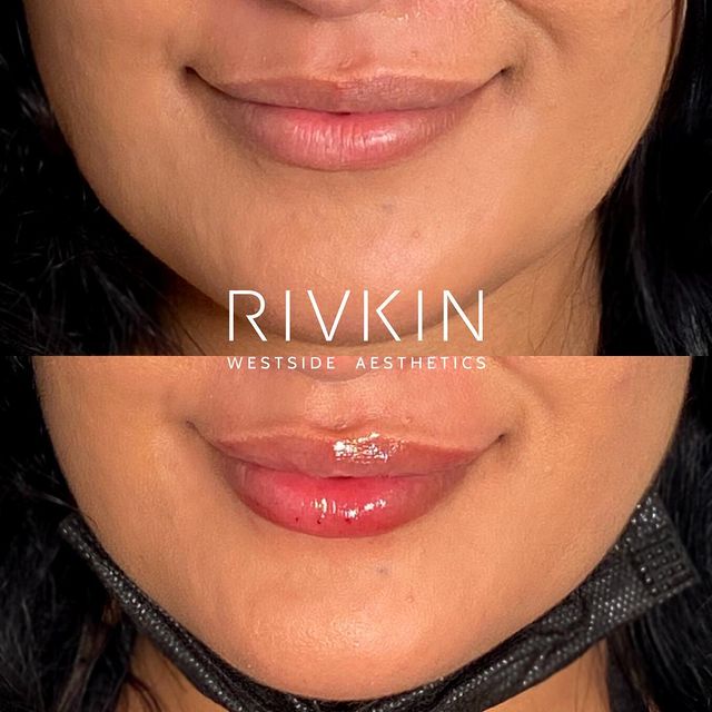 woman before and after a procedure with dr rivkin