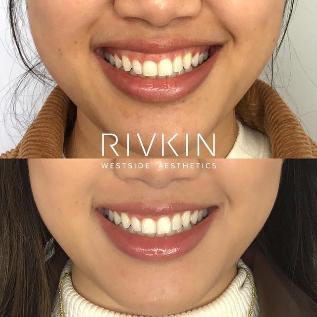 woman before and after a procedure with dr rivkin