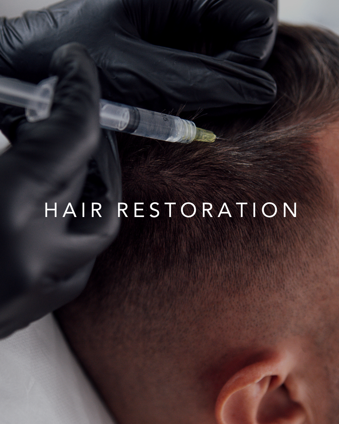 HAIR RESTORATION - PRP or Exosome Injections w/ at Home Care $1000