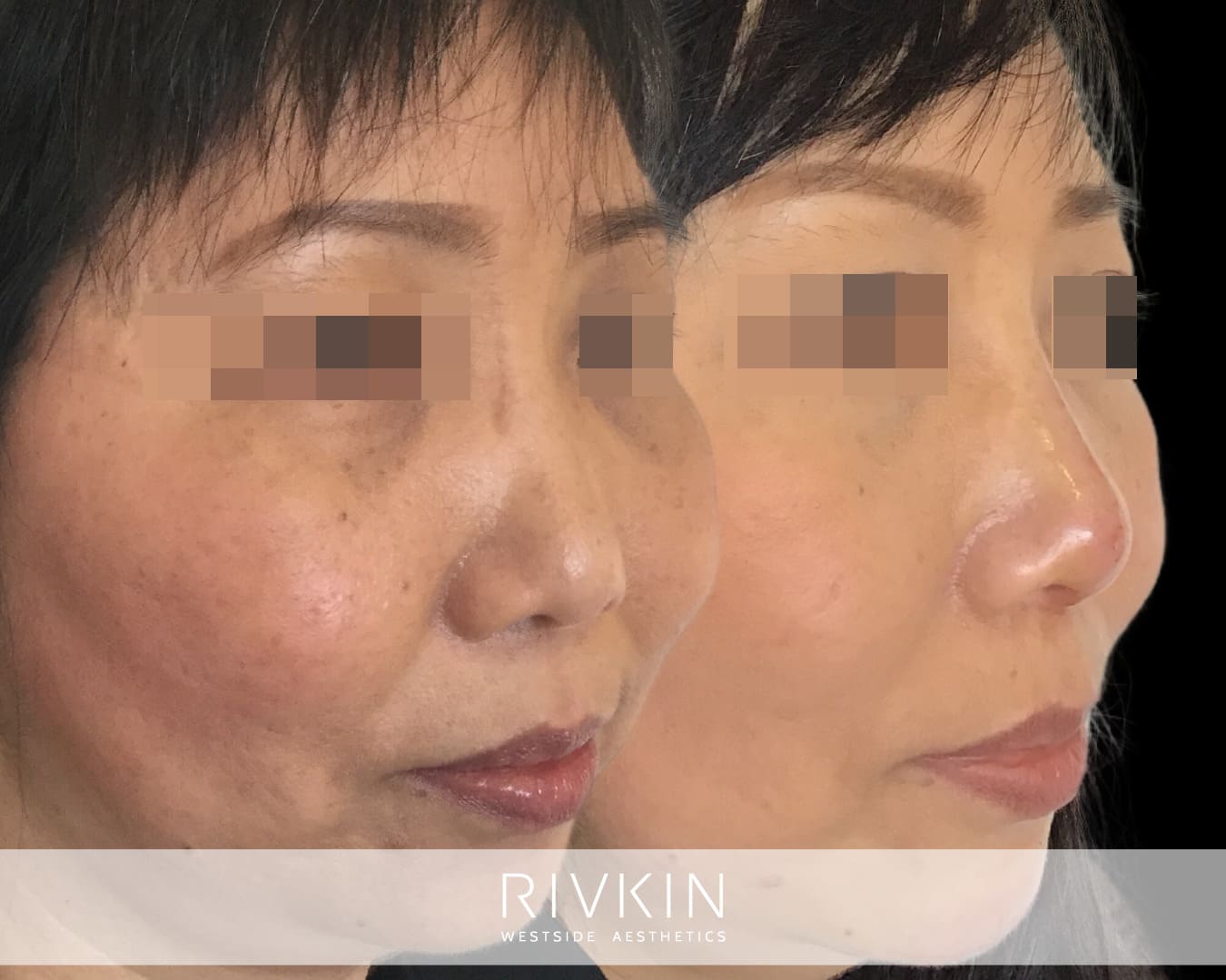 Asian Non-Surgical Nose Job