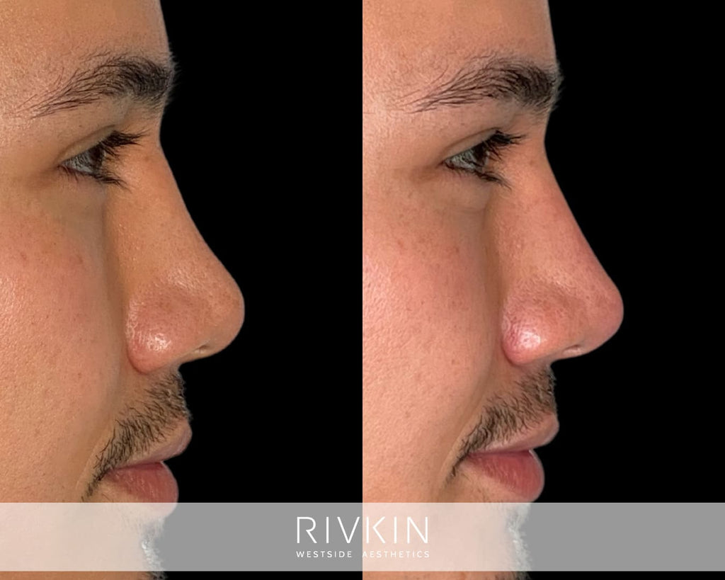 Asian Non-Surgical Nose Job