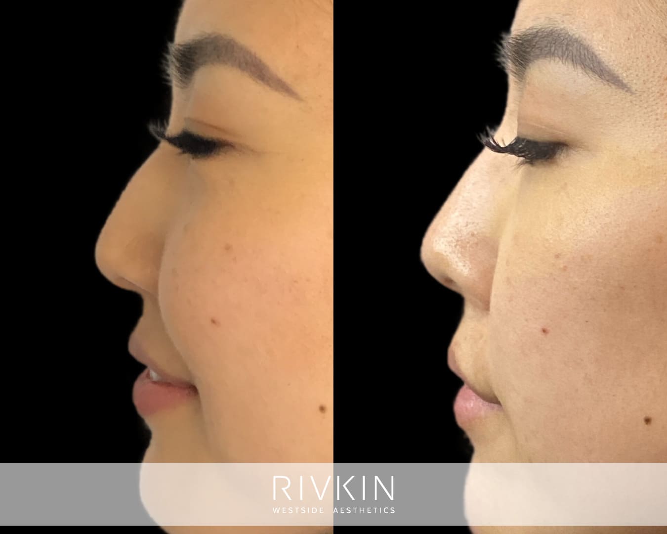 Asian Non-Surgical Nose Job