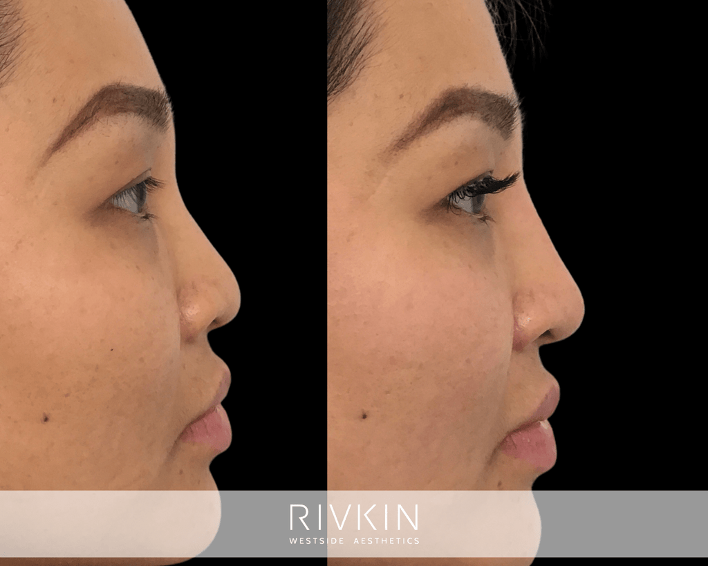 Asian Non-Surgical Nose Job