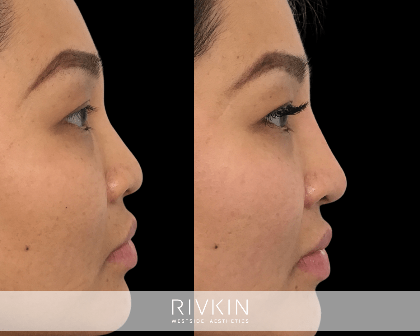 Asian Non-Surgical Nose Job