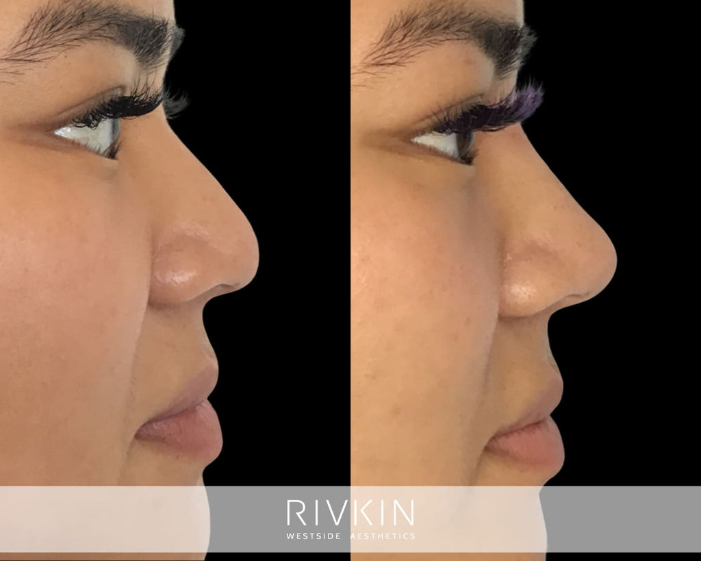 Asian Non-Surgical Nose Job