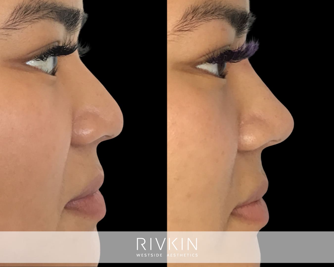 Asian Non-Surgical Nose Job
