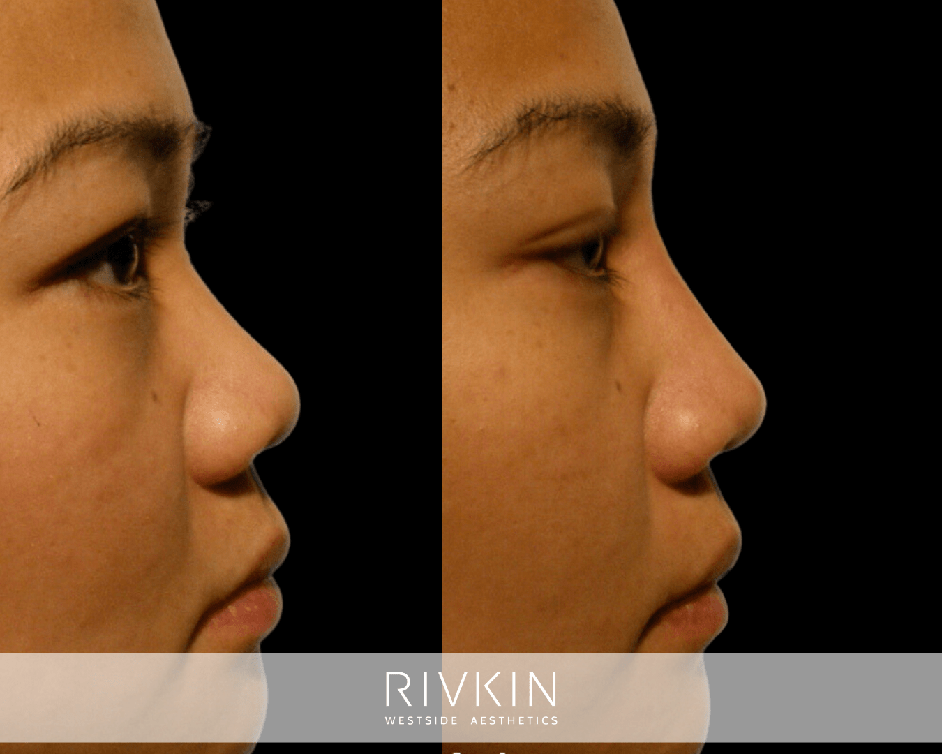 Asian Non-Surgical Nose Job