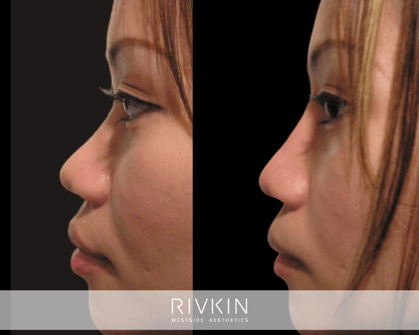 Asian Non-Surgical Nose Job