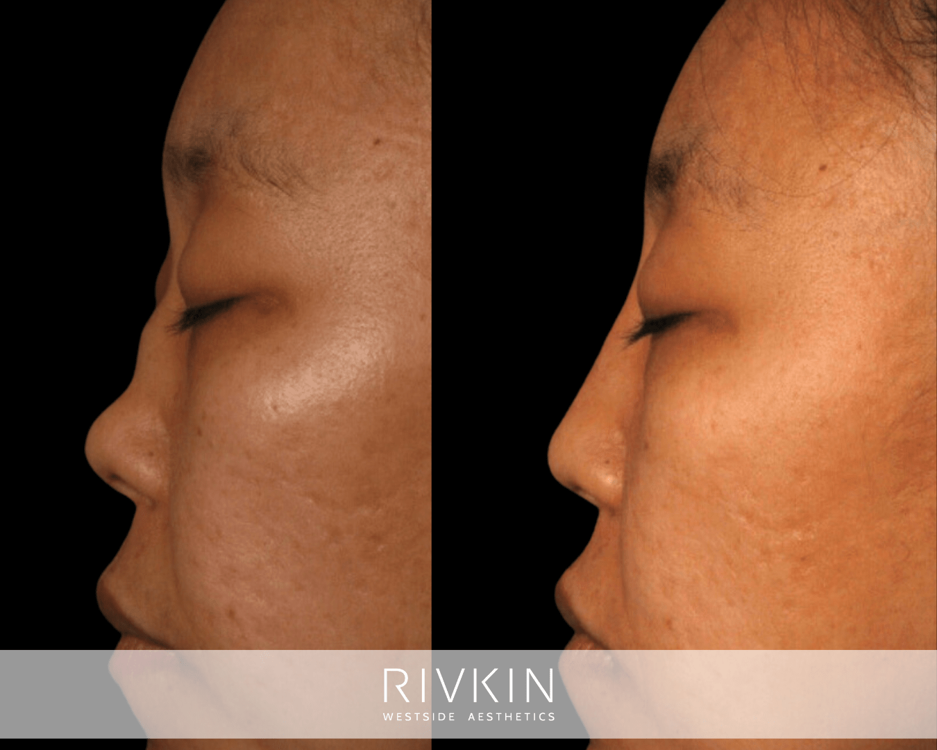 Asian Non-Surgical Nose Job