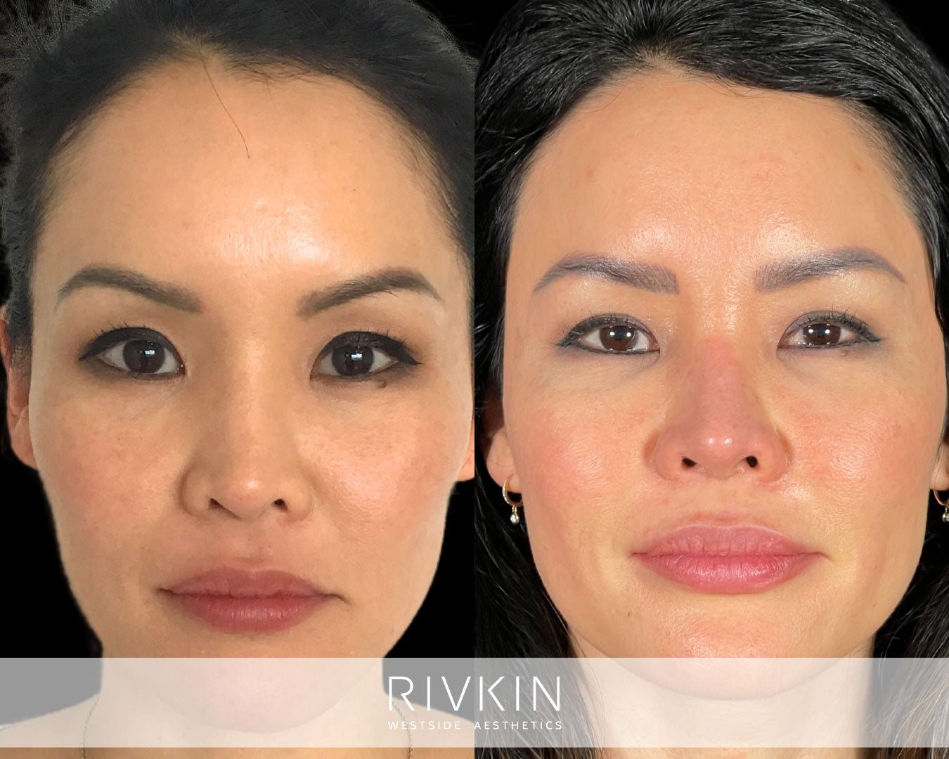Asian Non-Surgical Nose Job
