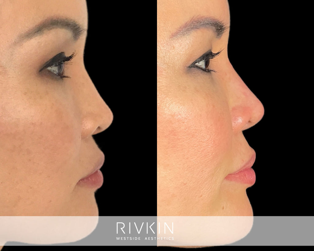 Asian Non-Surgical Nose Job