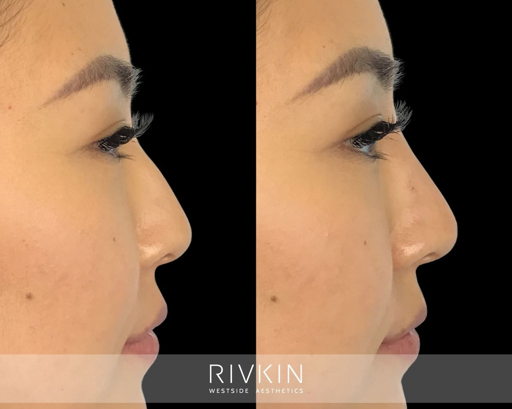 Asian Non-Surgical Nose Job