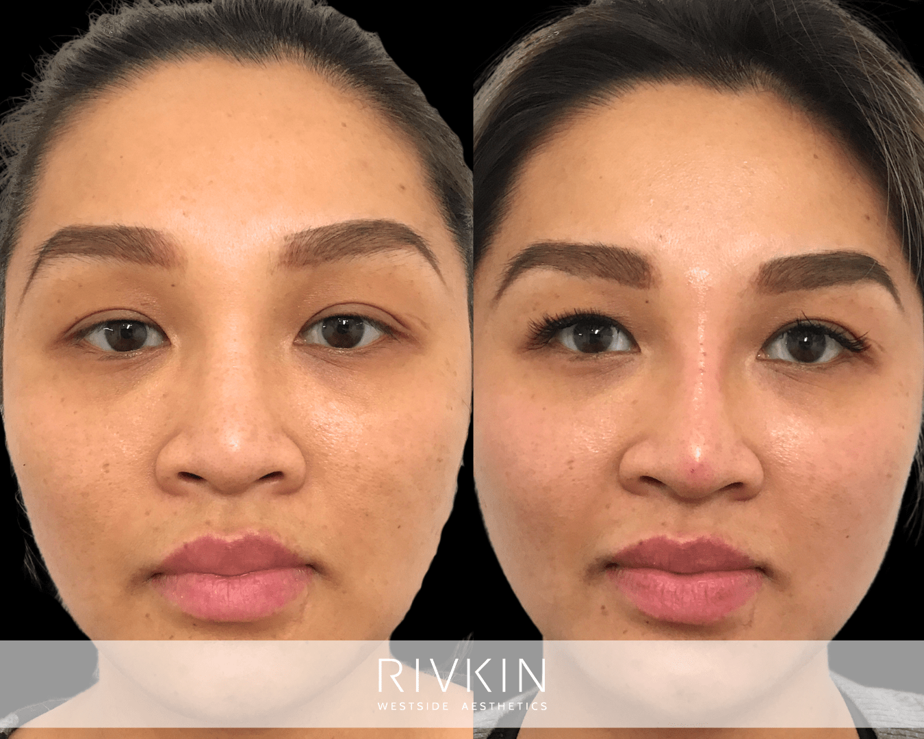 Asian Non-Surgical Nose Job