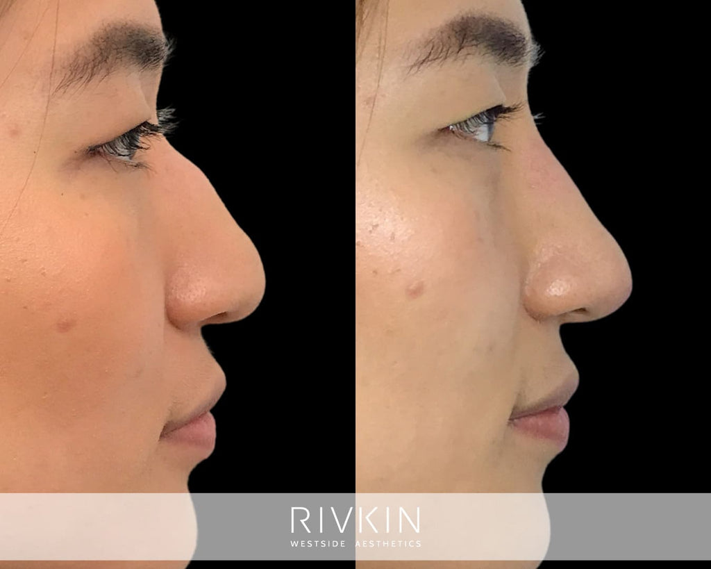 Asian Non-Surgical Nose Job