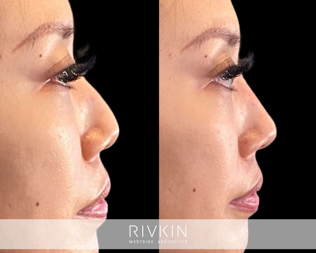 Asian Non-Surgical Nose Job