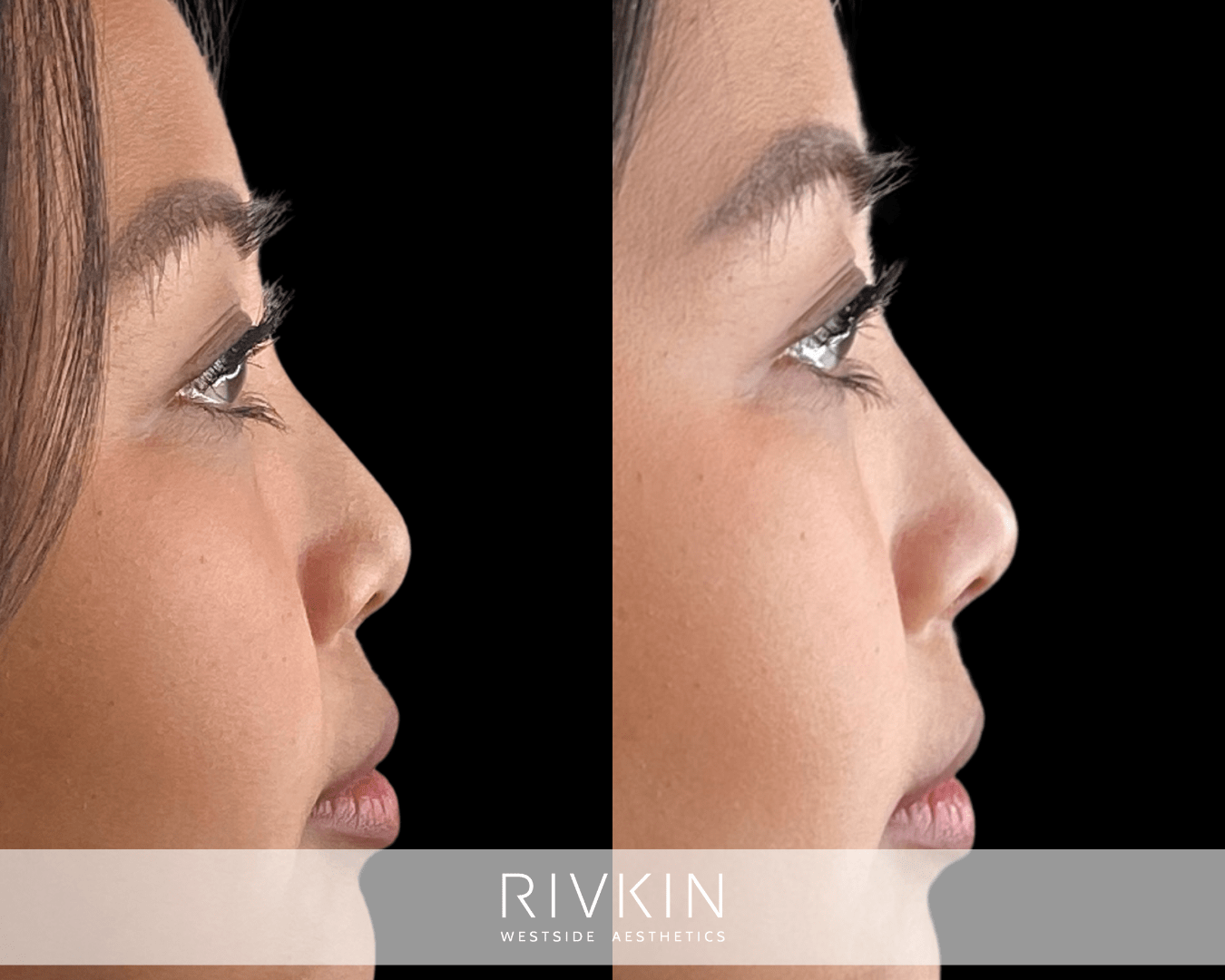 Asian Non-Surgical Nose Job