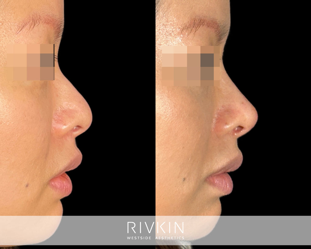 Asian Non-Surgical Nose Job