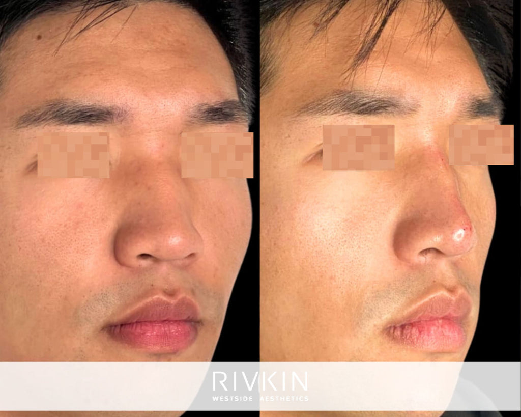 Asian Non-Surgical Nose Job