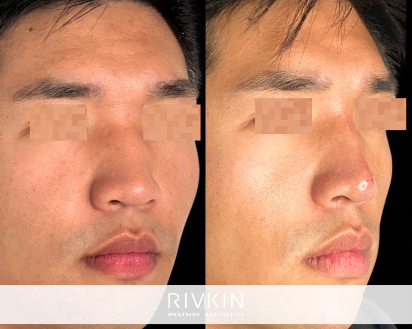 Asian Non-Surgical Nose Job