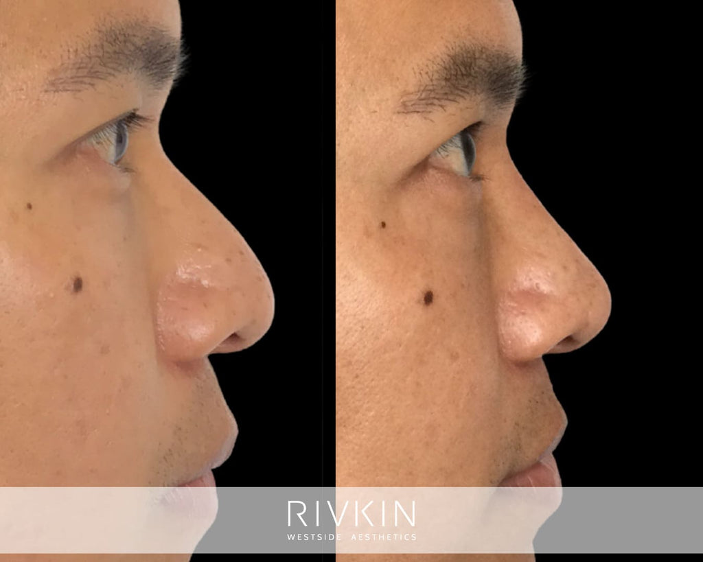 Asian Non-Surgical Nose Job