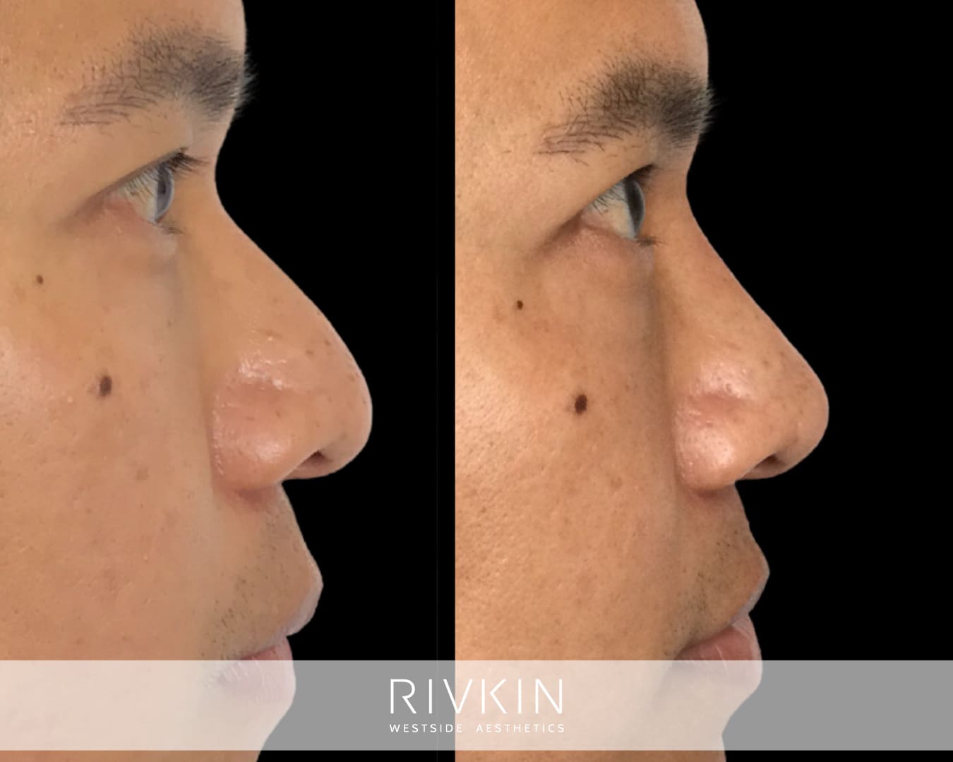 Asian Non-Surgical Nose Job