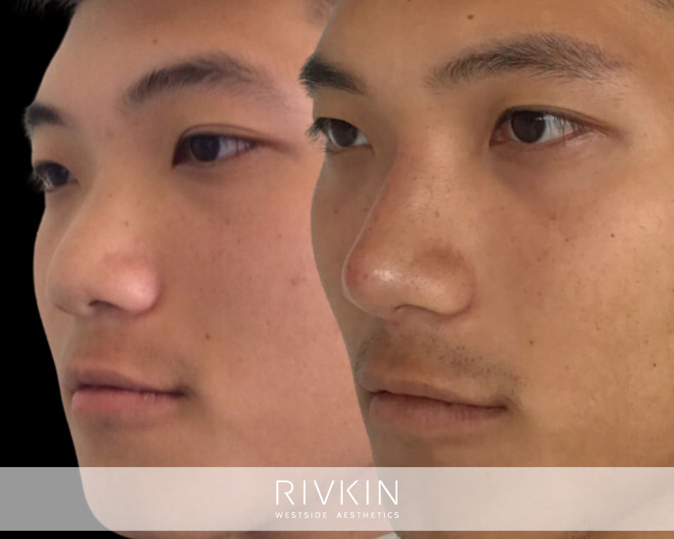 Asian Non-Surgical Nose Job